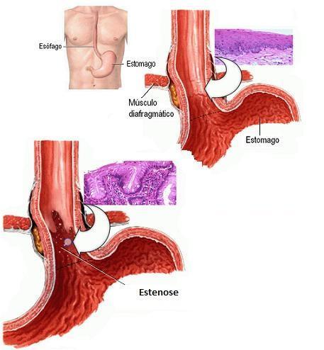 Obstrução física da faringe ou do esófago: Os tumores dos tecidos circundantes da faringe e esófago: Podem comprimir a faringe e esófago, levando à obstrução. Esta é uma causa rara de disfagia.