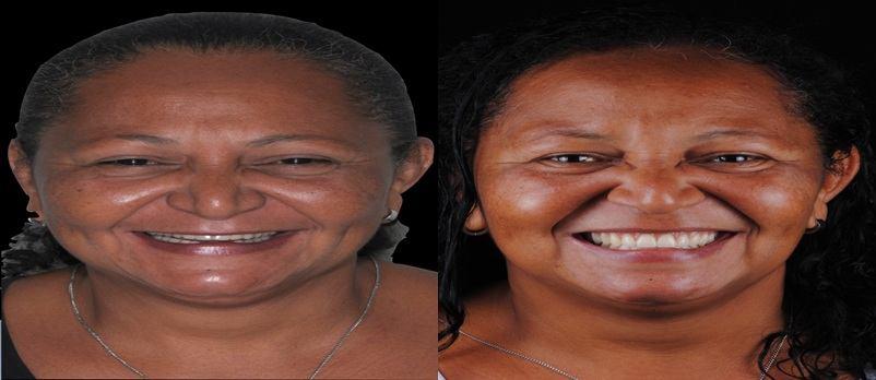 Figura 7: Desenho Digital do Sorriso Figura 8: Fotos finais. Caso finalizado (Antes e Depois).
