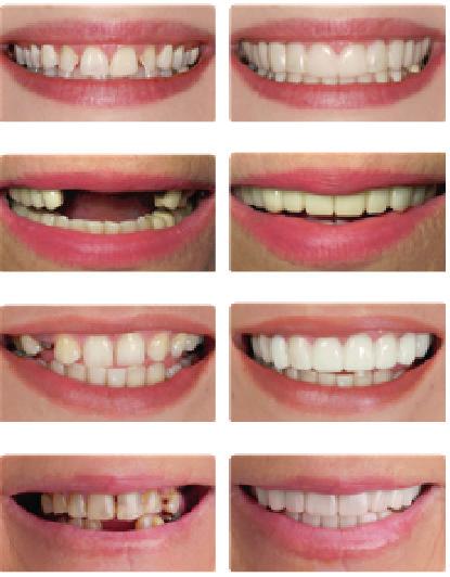 SnapOn Smile redefine o conceito de provisórios. O Snap On Smile não é invasivo, é fácil de usar e seu paciente vai adorar. Chega de procedimentos complicados que requerem muito de seu precioso tempo.