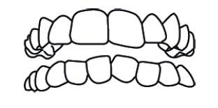Contra Indicações Doenças Periodontais Severas: Mobilidade dentária generalizada, bolsa periodontal