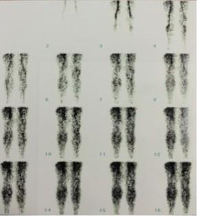 Imagem 2: Cintilografia óssea trifásica com 99mTc- MDP fase de fluxo.