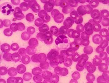 No eritrograma os resultados obtidos foram: hemácias (4,6 x10 6 /L); hemoglobina (9,8 g/dl); hematócrito (31,4%); VGM (68,3 fl); CHGM (31,2 g/dl) e plaquetas (45x10 3 /L); concluiu-se anemia