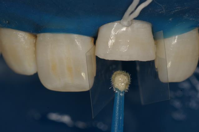 Reposicionamento e adaptação do fragmento dental ao remanescente coronário, com auxílio de resina composta (Filtek Z350 XT A2B). Figura 9.