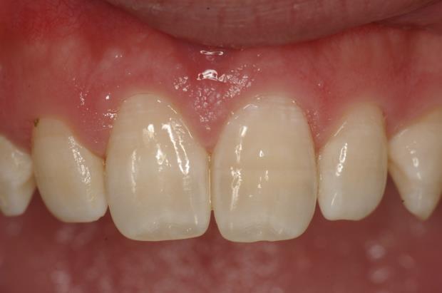A colagem dentária só se tornou possível com a evolução dos materiais restauradores adesivos, os quais permitem retenção e estabilidade do fragmento colado.
