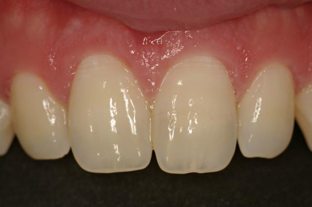 Com a execução do planejamento proposto, devolveu-se a forma original ao dente, sua função oclusal e mastigatória, e estética ao sorriso do paciente, através de uma técnica conservadora, sem desgaste
