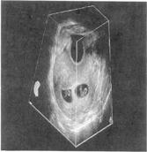 tilt 51 Scan rotacional Three-dimensional imae of a prenant uterus with twins. The imae has been "sliced to reveal the two estational sacs.