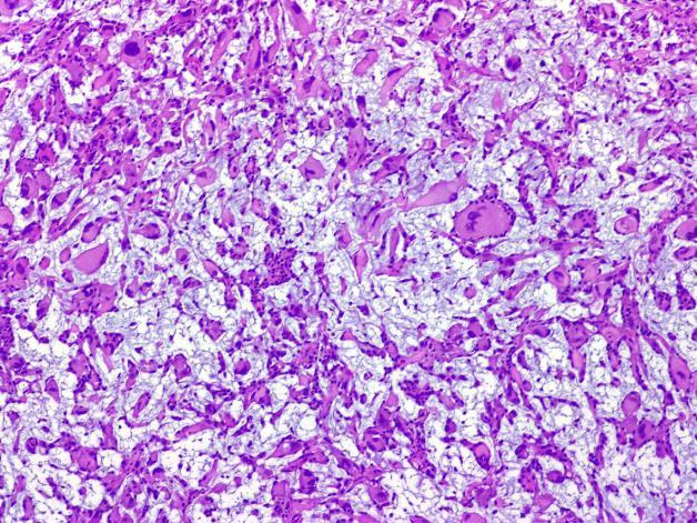 21 Revisão da Literatura Figura 3 Mixofibrossarcoma: Tumor com matriz mixóide e células tumorais eosinofilicas (HE x 100) Fonte: Neagu et al.
