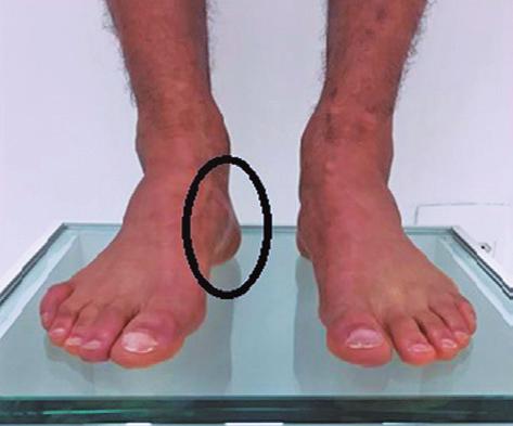 INTRODUÇÃO O pé cavo varo é uma deformidade complexa caracterizada pelo aumento do arco plantar longitudinal medial, pela flexão plantar do primeiro metatarso e varismo do retropé.