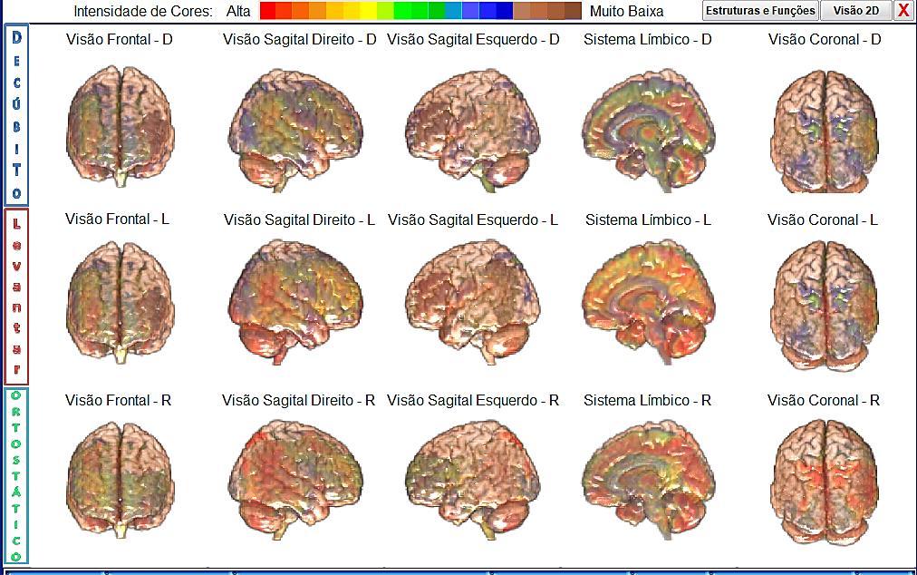 Interpretação do Cérebro Emocional e o Cérebro Racional, As imagens do cérebro mostram uma pessoa com uma predominância de baixa atividade cerebral nas três posições.