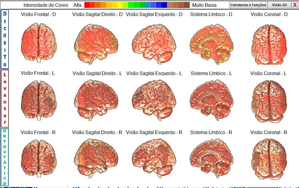 Durante a analise de DlO podemos observar pouca variabilidade nas regiões do cérebro durante as três posições.