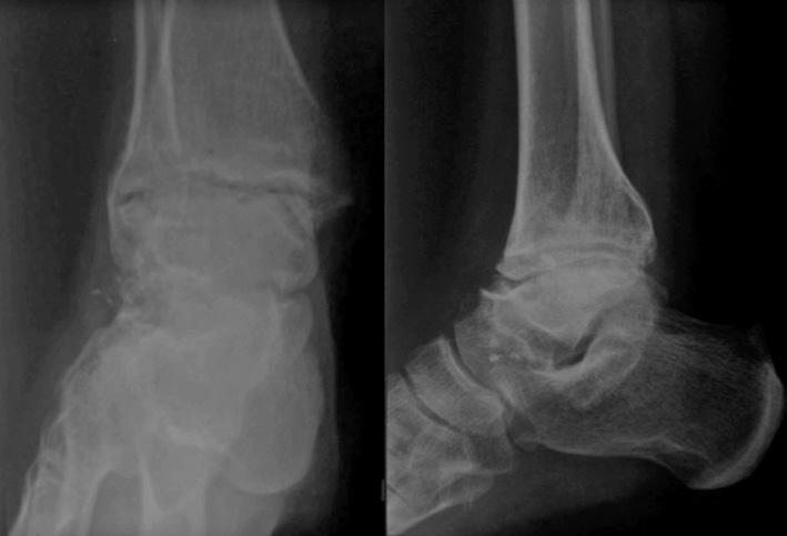 Na literatura há poucos trabalhos que relatam resultados e desafios relacionados à artroplastia total do tornozelo (TT) em pacientes hemofílicos, já que abordam em sua grande maioria as articulações