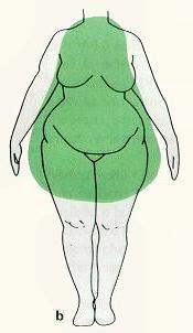 Existem dois tipos de obesidade Obesidade subcutânea (Ginóide) Acúmulo