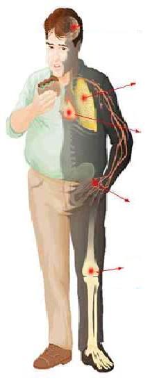 Doenças relacionadas à Obesidade LITÍASE BILIAR: Pode causar cólica biliar ou colecistite aguda.
