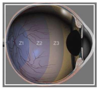 Classificação da ROP A classificação é baseada na classificação internacional da retinopatia da prematuridade atualizada.