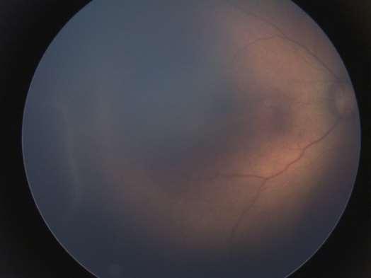 Classificação - severidade Estágio 1: formação de uma linha de demarcação plana e acinzentada que separa a retina vascular da avascular ( figura 6). Fig.