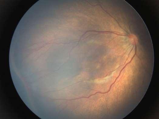 Classificação - severidade RETINOPATIA DA PREMATURIDADE Estágio 3: presença de neovasos associados à crista do estágio 2.