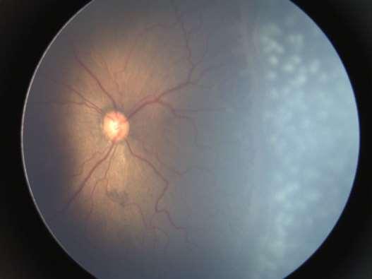 Fig.11: Olho direito logo após a ablação retiniana com laser