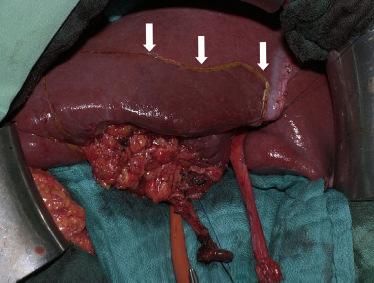 Operação padrão - Neoplasia da vesícula biliar com