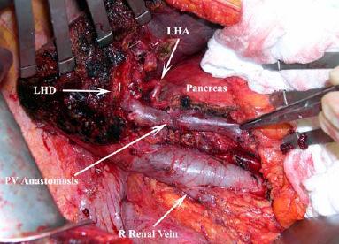 - Trissegmentectomia D com duodenopancreatectomia.