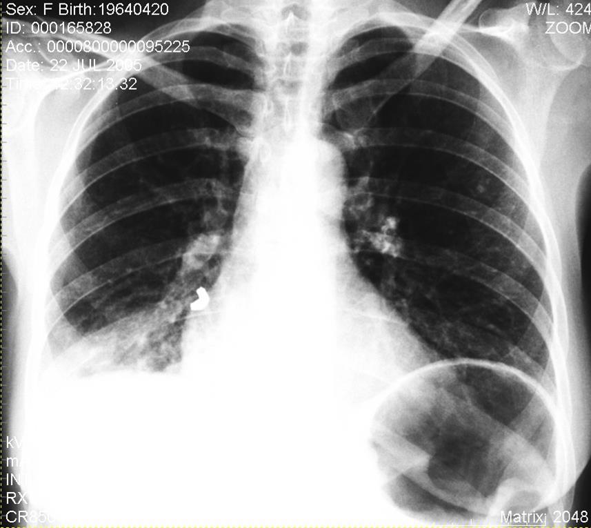pneumonia lobar em DPOC) Figura