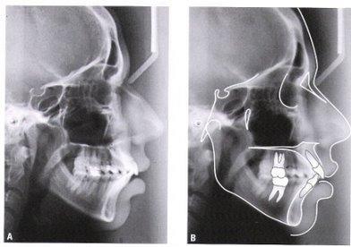 18 Figura 3 A,B,C: Fotos intrabucais, pré-tratamento fonte: