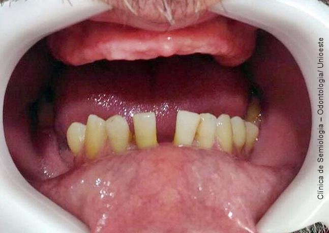 diastema entre