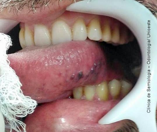 macroglossia e