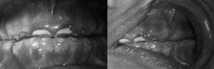 FIGURA 2: Vistas frontal e lateral da cavidade bucal da mãe da criança do caso 1. a criança não apresentava nenhuma doença sistêmica.