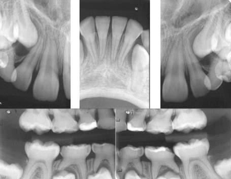 No entanto, a paciente não apresentava sintomatologia dolorosa nem sensibilidade dentinária, possuindo ótima saúde periodontal.