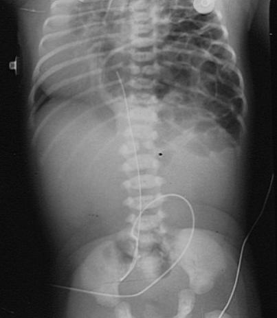 B. Hernia Diafragmática Formatípica referida como Bochdaleck Dificuldade respiratória Pode