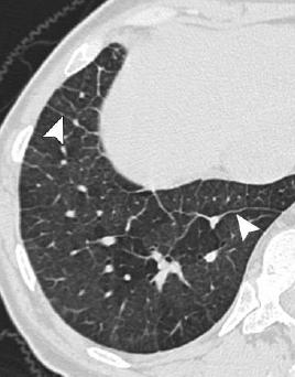 1. Hipertensão Arterial Pulmonar(HAP) 1.1. Idiopática 1.2. Hereditária 1.3. Induzida por drogas ou toxinas 1.4.