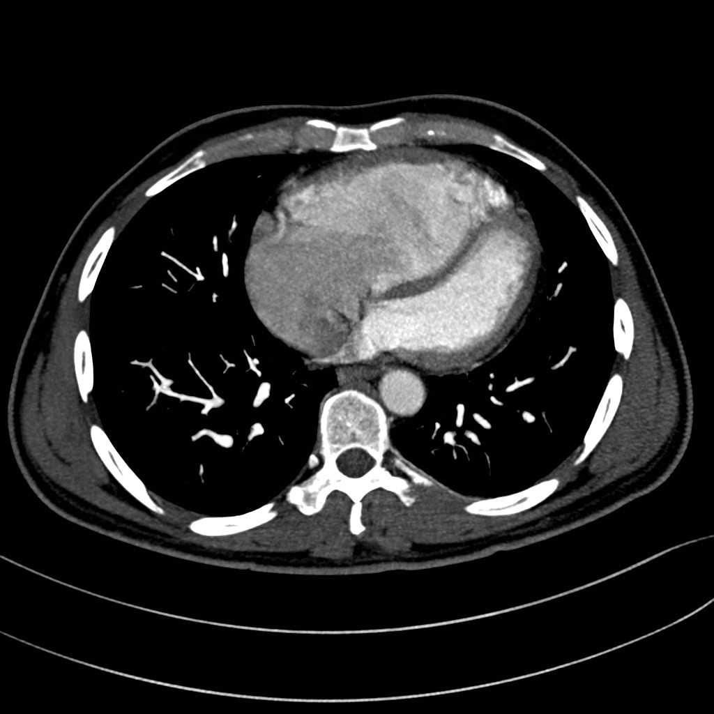 Hipertensão Pulmonar por mecanismos multifatoriais não evidentes Uma das causasmaiscomuns de HP.