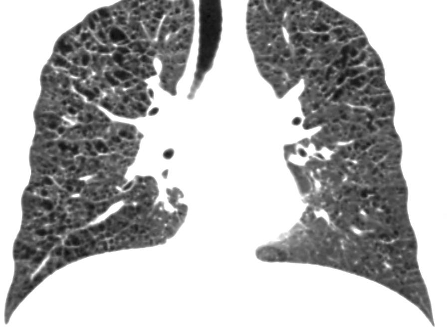 Doença Pulmonar Veno-oclusiva e Hemangiomatose Capilar Pulmonar 2. Hipertensão Pulmonar por Cardiopatia Esquerda 3. Hipertensão Pulmonar por Doença Pulmonar ou Hipóxia 4.