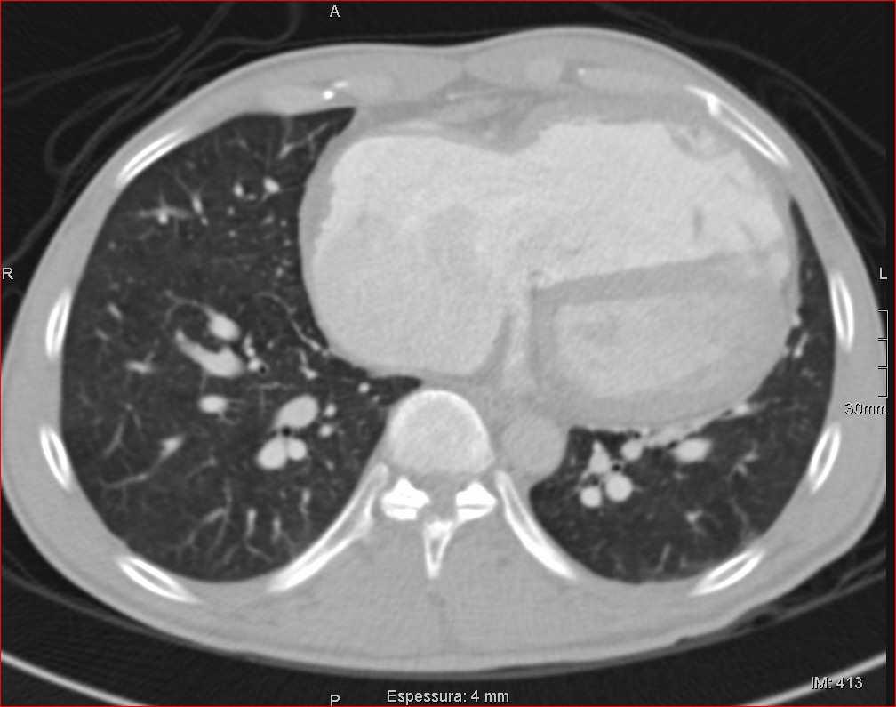 JTI 2013;28(2):96-103 Diâmetro das artérias pulmonares