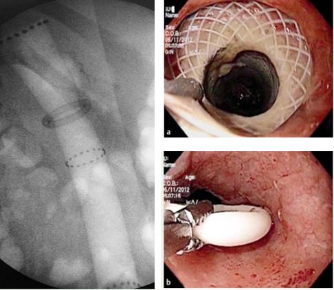 As próteses endoscópicas também podem ser utilizadas como primeira opção para o tratamento da obstrução por anel não erodido ou como salvamento nos pacientes em que a ruptura do anel não foi possível