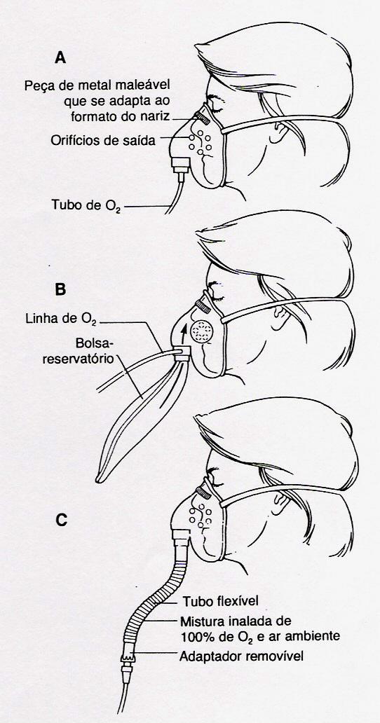 As máscaras tipo nebulização/venturi permitem um controle da concentração de oxigênio,