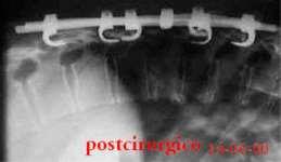 Ilustração 3: Coluna Torácica com Haste Implantada Ilustração 4: Haste e Gaiola em Titânio 3.