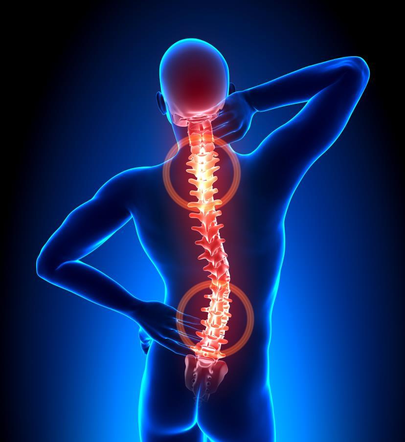 As consequências da má postura Escoliose Surge quando a má postura faz a espinha dorsal se curvar para o lado.