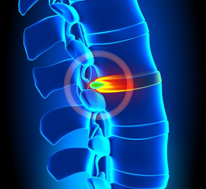As consequências da má postura Hérnia de disco O corpo humano conta com discos intervertebrais de consistência cartilaginosa, localizados entre as vértebras da coluna, para amortecer o impacto entre
