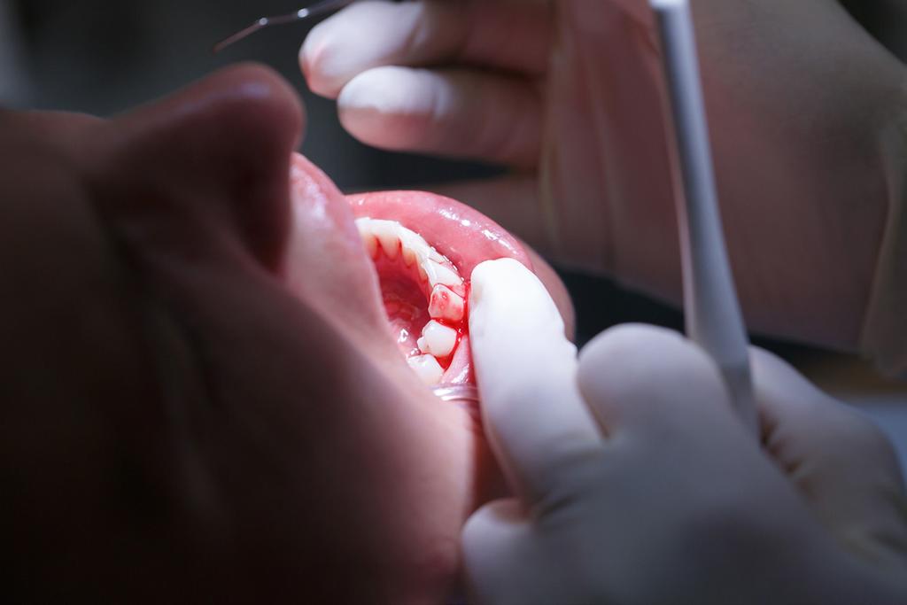 Doença periodontal Gengivite e periodontite A gengivite e a periodontite são doenças infecciosas que têm como principal causa a placa bacteriana, mas são resultados de diferentes respostas dadas pelo