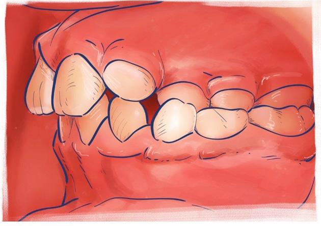 Mordida cruzada: normalmente a arcada superior deve sobrepor a arcada inferior. Nesse caso, acontece o contrário, com os dentes inferiores mais salientes.