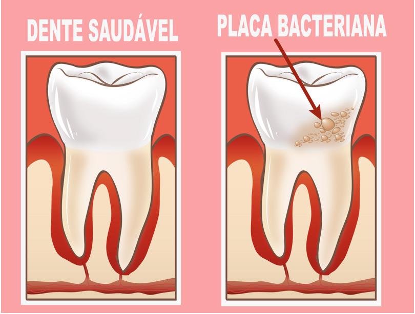 Placa bacteriana A placa bacteriana ou o biofilme é uma camada gelatinosa, incolor ou esbranquiçada, constituída por bactérias e restos alimentares que se depositam sobre a superfície dos dentes.