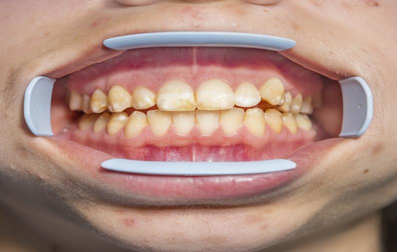 Fluorose dentária A Fluorose dentária é o aparecimento de manchas na superfície do dente devido à exposição excessiva ao flúor no período de sua formação (germe dentário).
