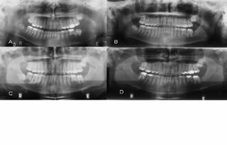 Após 18 meses de controle a cânula foi removida e realizou-se a cistectomia do CD. A erupção completa do dente 37 ocorreu 18 meses após a cistectomia do CD (Figura 1B).