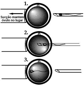 3. A figura ao llado mostra uma técnica de reprodução assistida que pode ajudar alguns casais com dificuldades em ter filhos. A técnica é conhecida pelo sigla inglesa de ICSI.