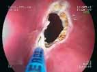 Desvitalizações e coagulações também no cólon direito Crescimento para dentro / excessivo do stent