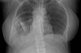 pulmonar por videotoracoscopia, com retirada de material amorfo e desbridamento de tecido necrótico em parede torácica seguida de colocação de dois drenos pleurais, coletado de material para culturas