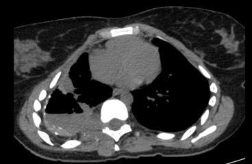 Figura 2 TCAR - janela pulmonar Figura 2 TCAR janela mediastinal Foi indicada toracotomia exploratória com descorticação e toracostomia com drenagem pleural anterior e posterior, com diagnóstico