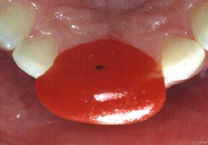 Figura 1: proteção dos dentes com vaselina para confecção do JIG.