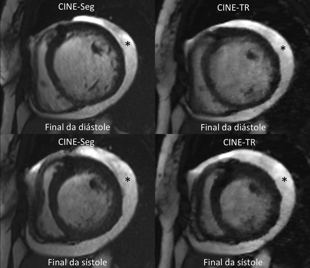 50 Figura 7: Imagens em eixo curto ao final da diástole e final da sístole ao nível médio do ventrículo esquerdo de uma paciente com cardiomiopatia dilatada de etiologia isquêmica.